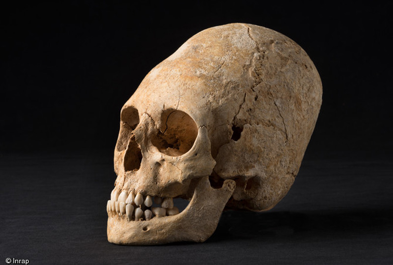 Deformed Skull In France